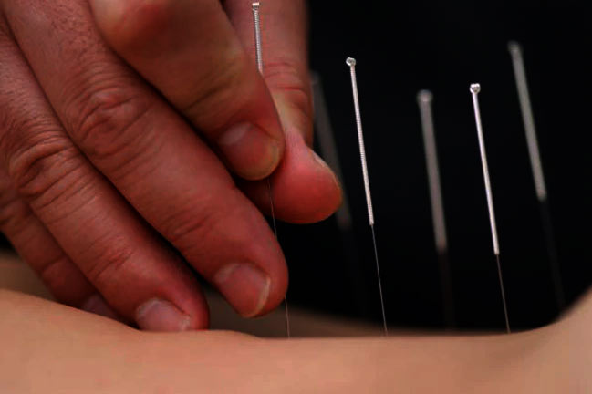 ACUPUNCTURA